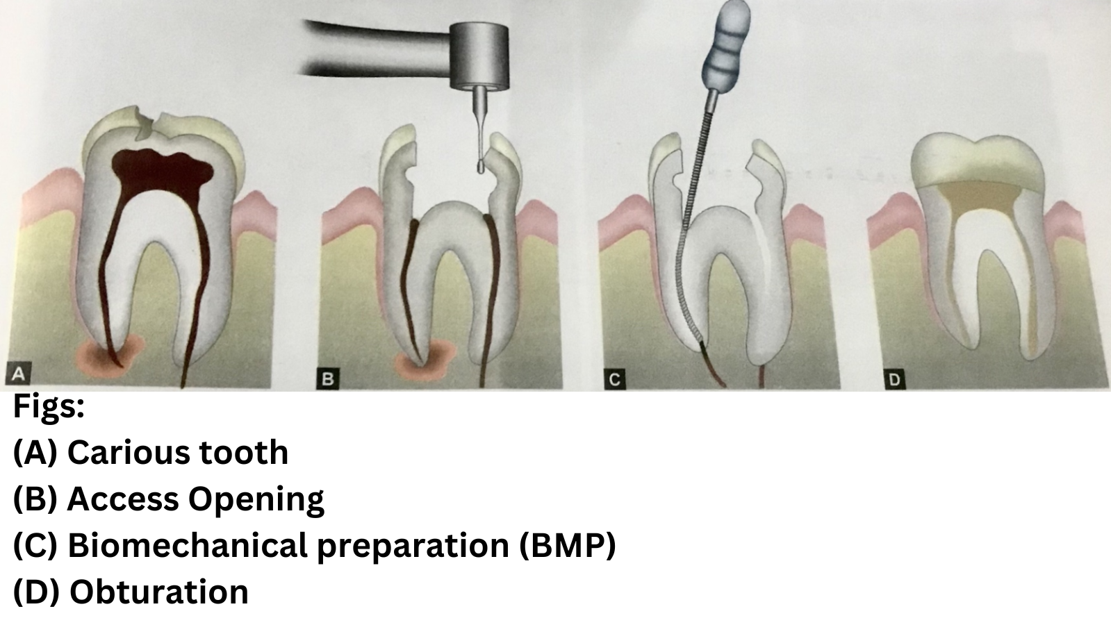 Pulpectomy