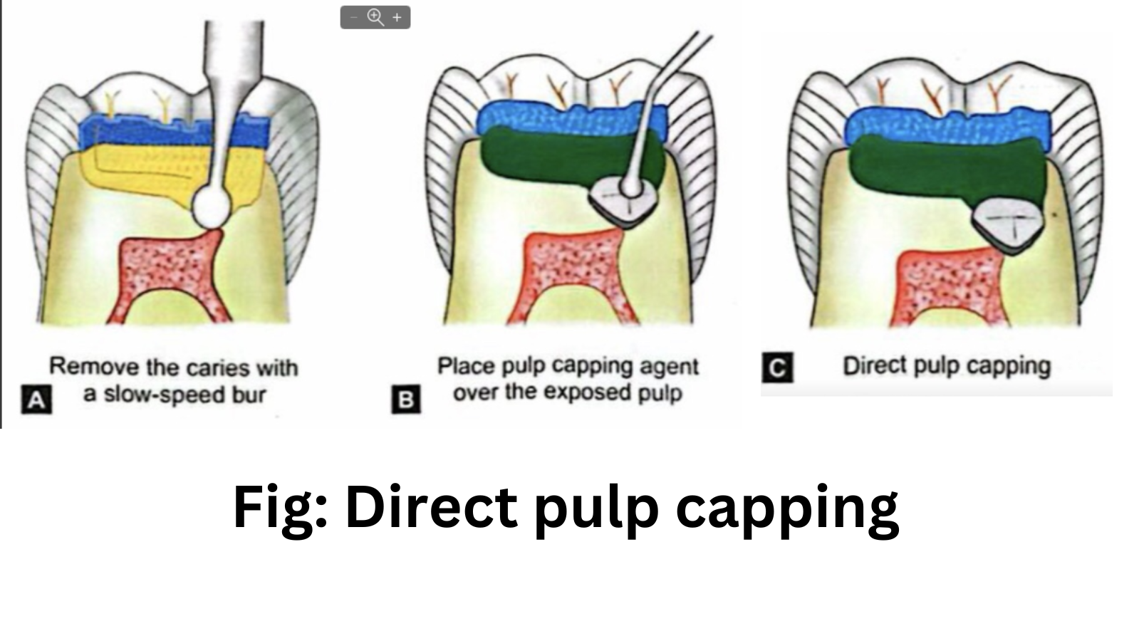 direct pulp capping