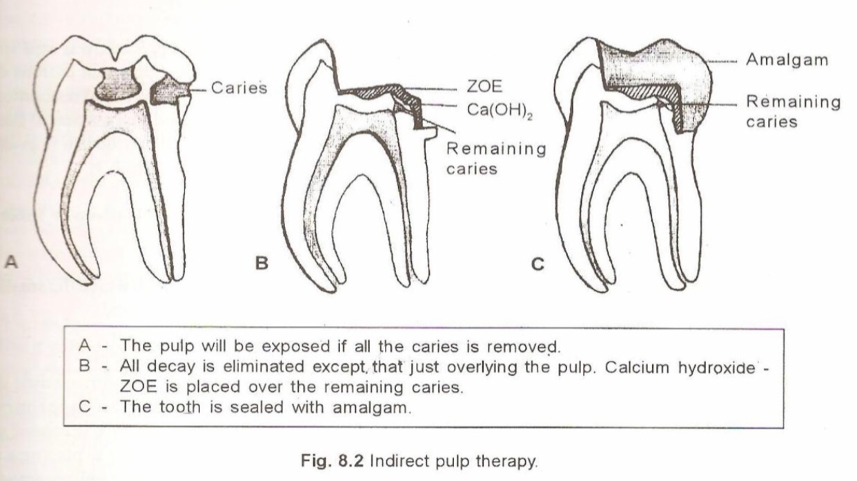 indirect pulp capping